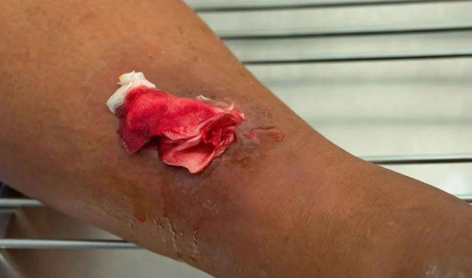 中腾生物带你了解,下肢静脉性溃疡伤口管理_进行_的评估_患者