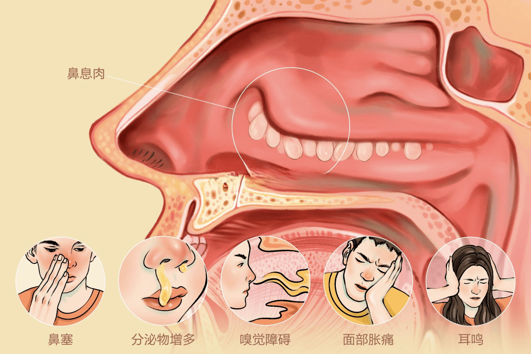 长了鼻息肉,一定要手术吗?北京首大眼耳鼻喉医院臧洪瑞主任为您解答!