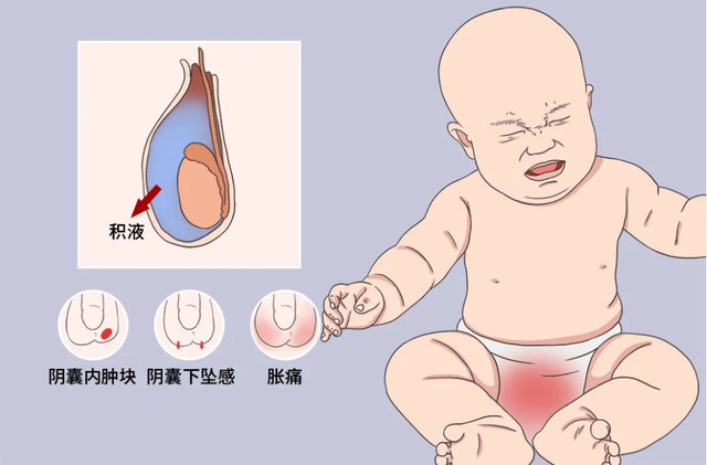 小孩睾丸下垂图片图片