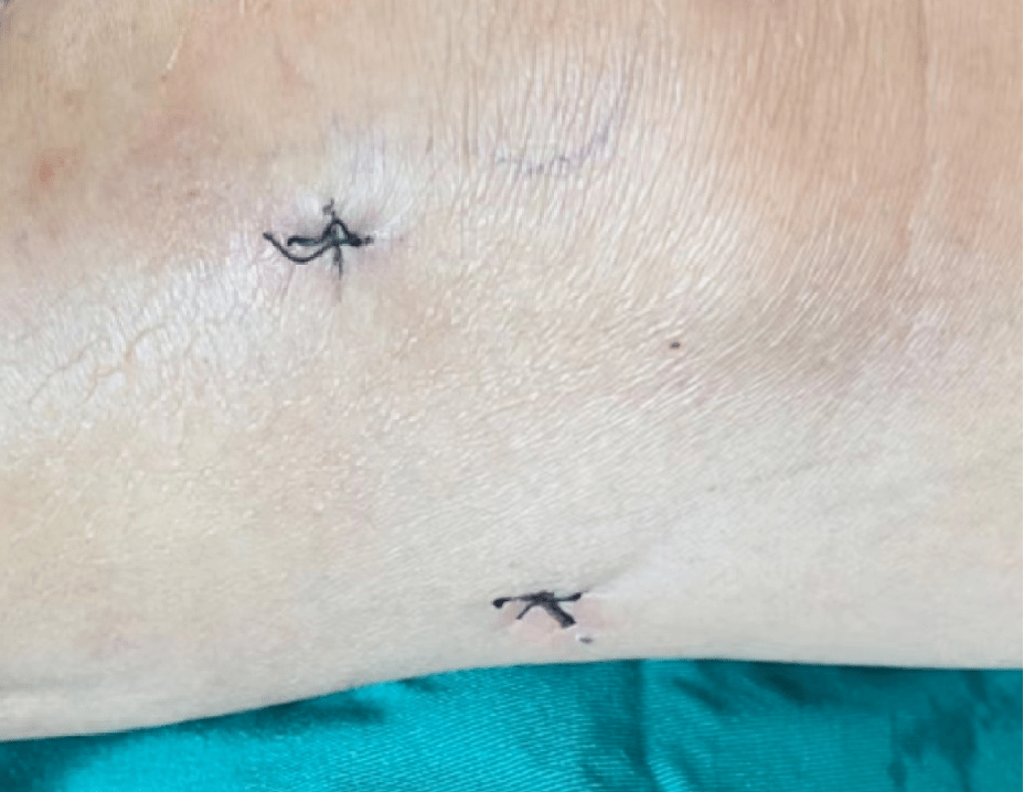 【医疗技术】微创技术巡展之关节镜:骨头缝里做手术,伤口只有豌豆大!