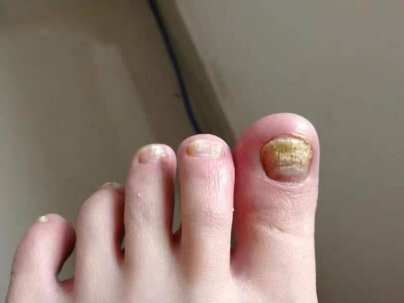 灰指甲危害很大!试试这个小妙招,帮你解决灰指甲!_效果_jun_食物