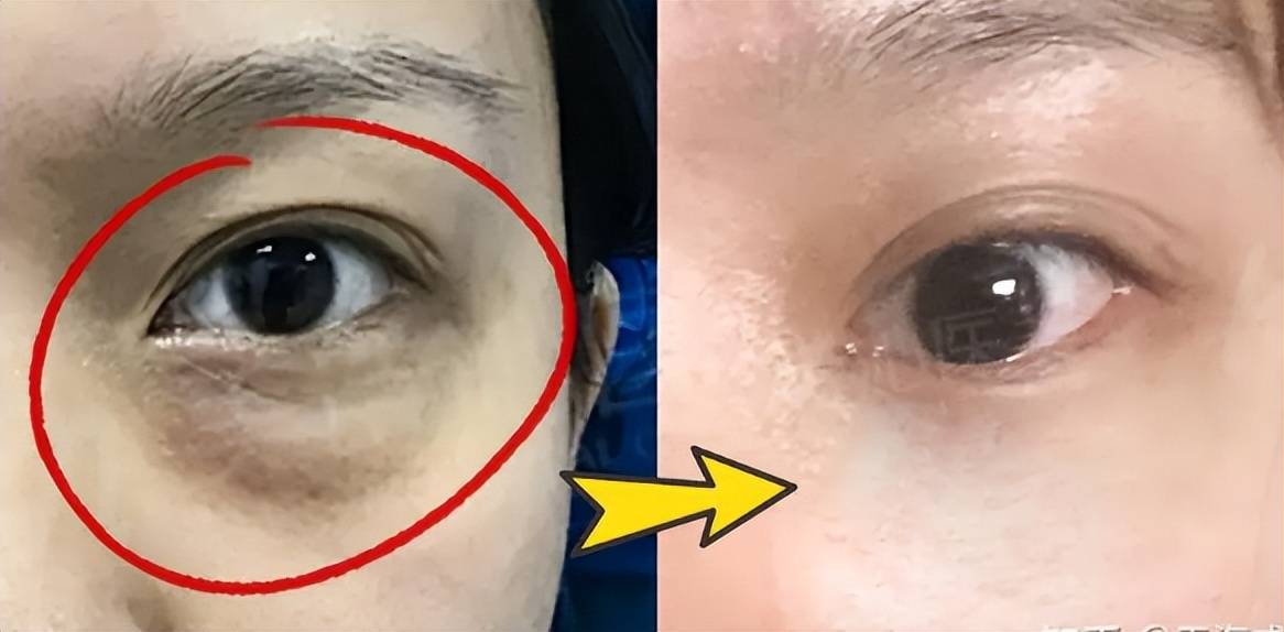 去眼袋手术警惕三大后遗症?_进行_伤口_皮肤