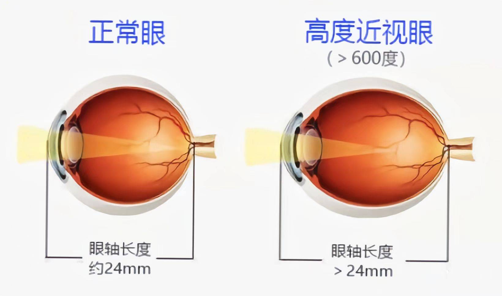 十大高度近视眼图片图片