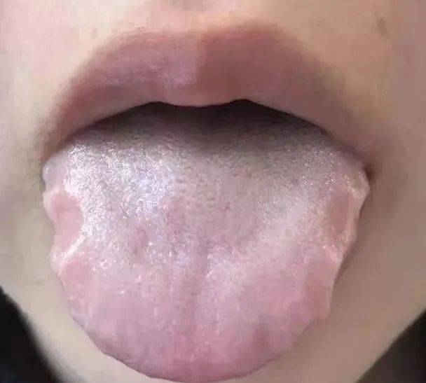 有些孩子是胖大舌,但是在伸出舌头时特别使劲用力,舌头被缩在一起,看