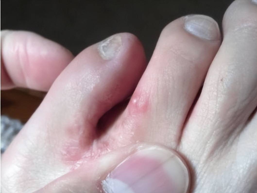 脚气脚痒能用手扣吗?过来人告诉你真相,这样做快速止痒杀菌!