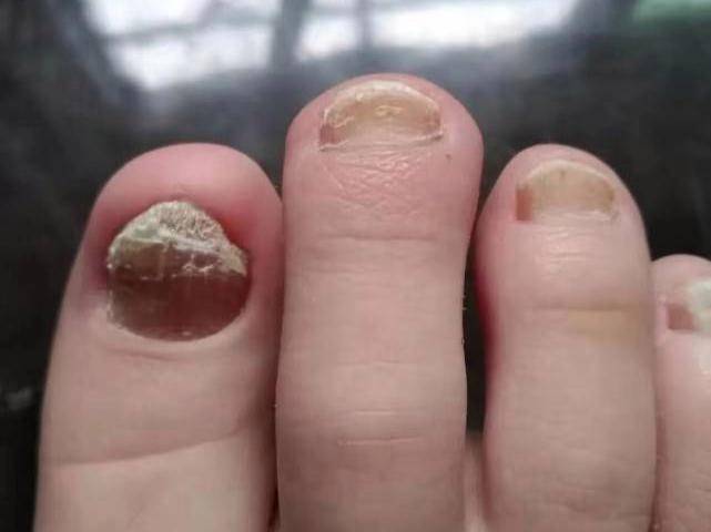 治灰指甲别只知道用亮甲!这招反而更快速有效!