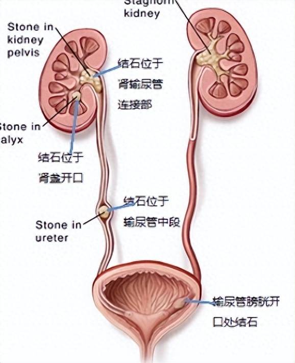 输尿管结石怎样排出图片