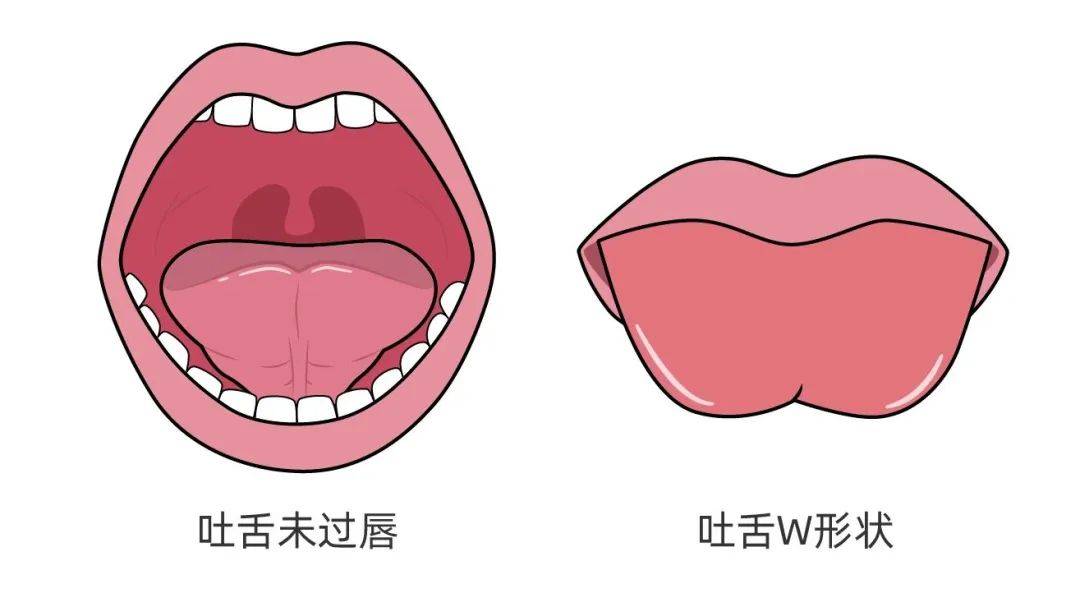 为了纠正这种情况,需要通过修整术来延长舌系带,术后还要配合语音训练