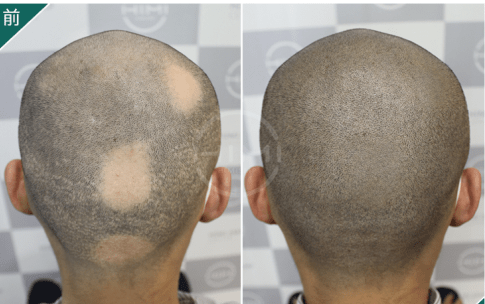 黑米3d纹发:脱发难缠,可能是起因太复杂用错方法!