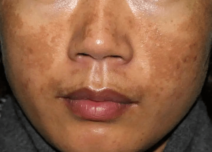 e,谷胱甘肽),美白剂(氢醌霜,熊果苷,氨甲环酸,左旋维c,间苯二酚等),去