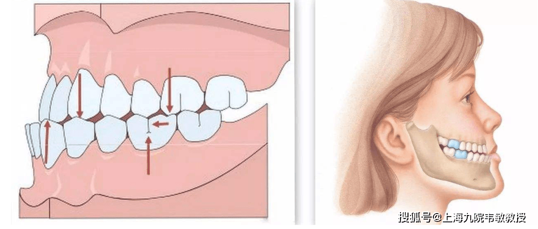 人工喂养的儿童,常因仰面用奶瓶喝奶,奶瓶压迫上唇部,下颌向前用力吸