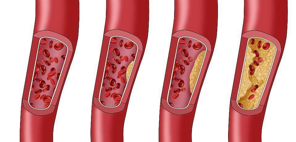 血管堵塞"过程你知道吗?该怎样预防它的堵塞呢?