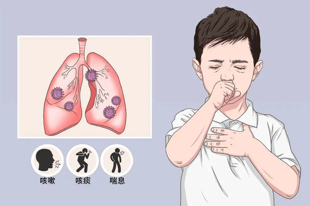 重症肺炎病程较长,即使体温正常,咳嗽咳痰也会持续一段时间,有的可能
