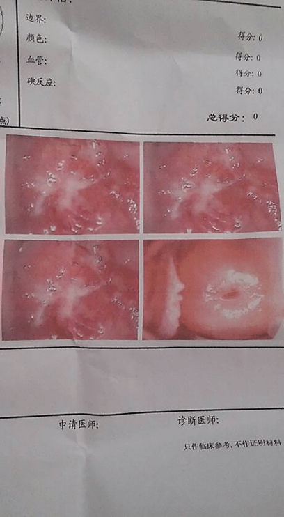 宫颈糜烂电灼术图片图片