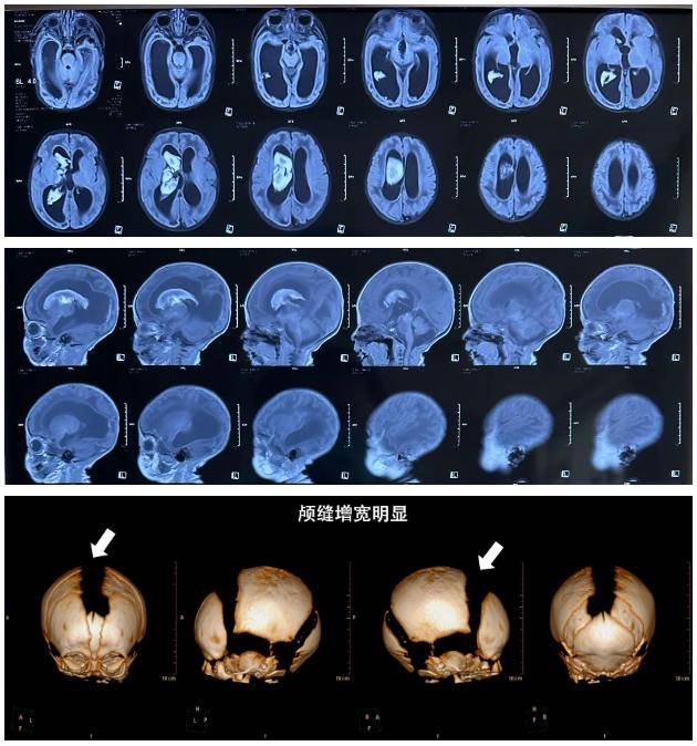 入院时头颅核磁提示脑出血并脑室重度扩张