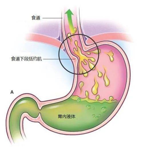 【高尚超聲】胃食管反流病_診斷_治療_症狀