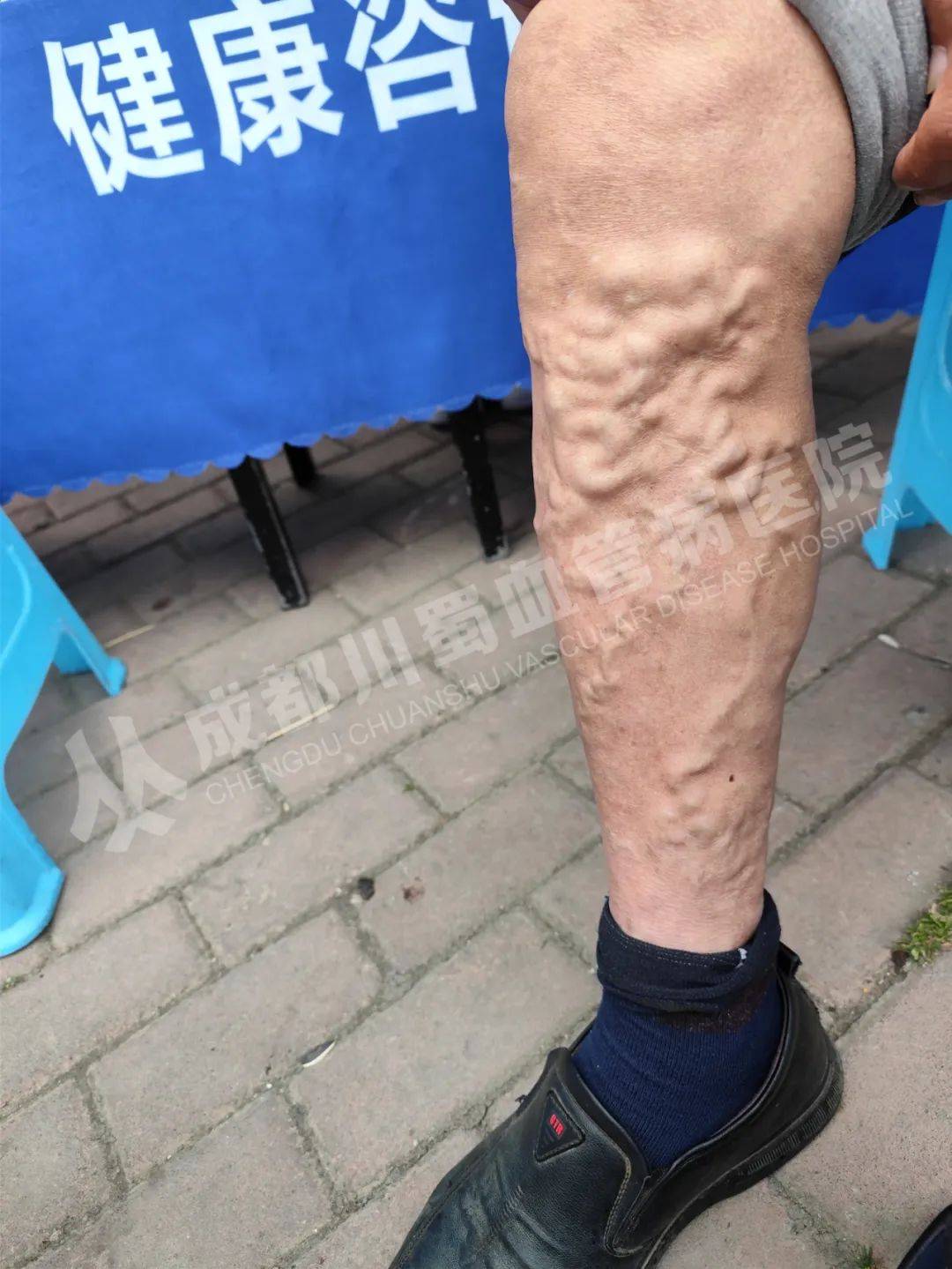 静脉曲张科普大揭秘:你真的了解它吗?_下肢_扩张_回流