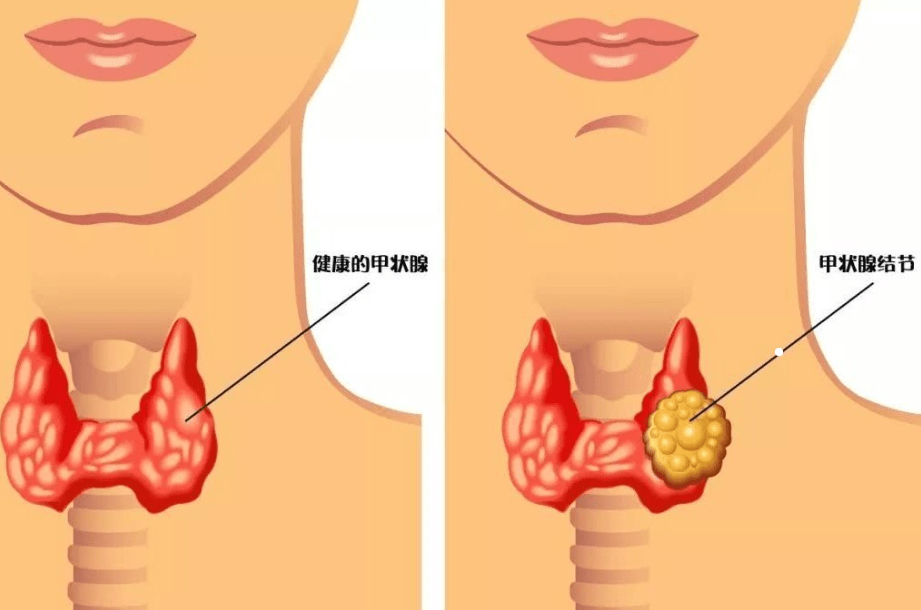 甲状腺的具体位置图片