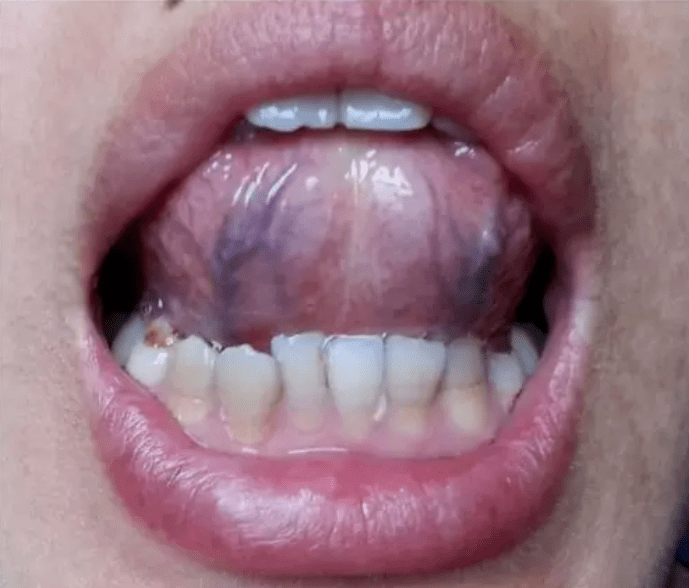 舌头背面血管发紫图片