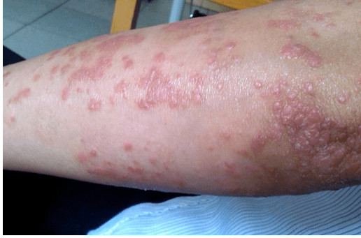 皮癣是红斑,水泡,丘疹,中间区自愈现象比较轻3,从发病部位来看湿疹