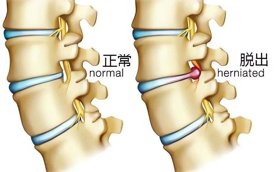 腰椎間盤突出症是一種常見的脊柱疾病,對患者的生活質量和健康狀況