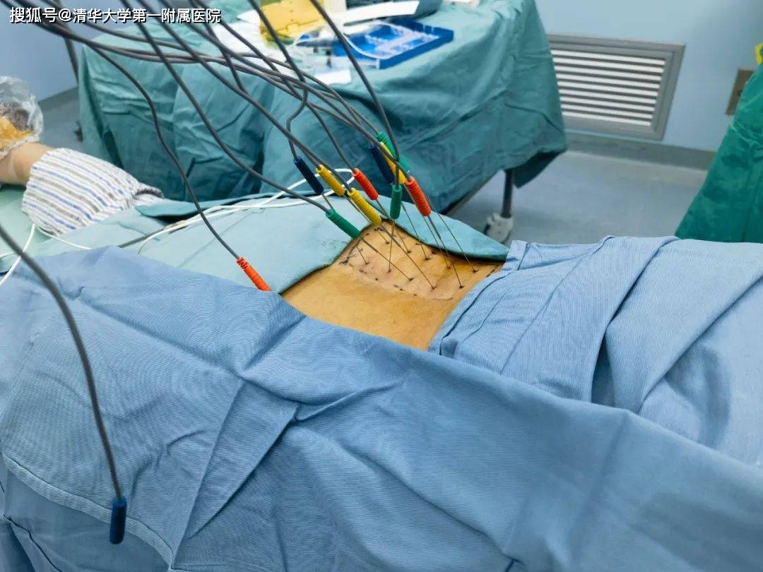 缓解颈肩腰腿痛的利器——清华一附院麻醉科疼痛专业组开展内热针导热