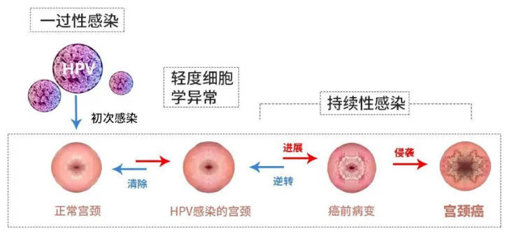 薇润提醒感染hpv不等于宫颈癌!_病毒_细胞_黏膜