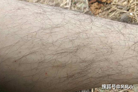 男人没有腿毛，说明体内雄激素偏低？如何增加男人味？