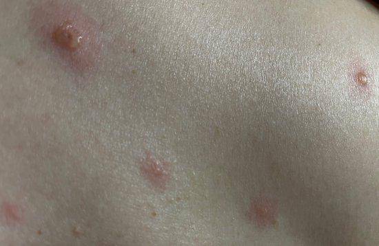 传染性强、人群遍及易感 水痘高发期怎么防？ 