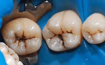 食物中的龋齿克星 牛奶上榜_牙齿_细菌_蔬菜