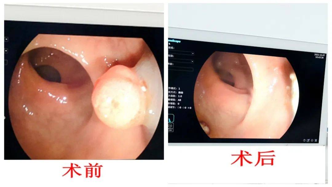 內鏡下消化道異物取出術,內鏡下胃腸息肉電切術,食道靜脈曲張套扎術及