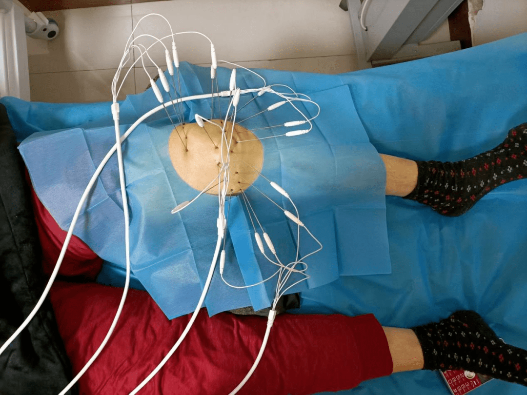 顽固性颈肩腰腿痛试试"内热针治疗技术"!