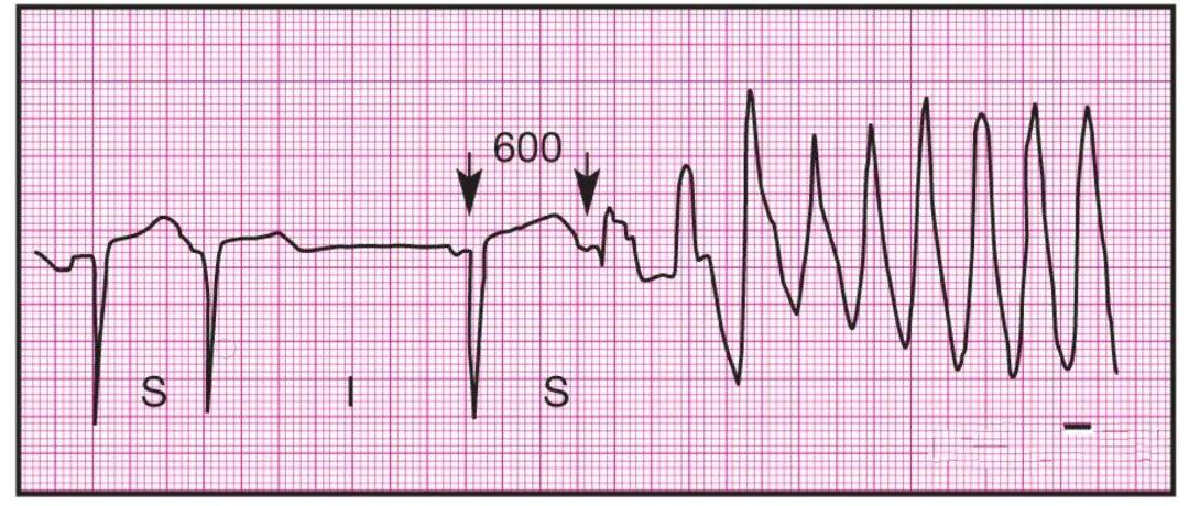 14種臨床最常見心電圖全收錄!_心室_特點_束支