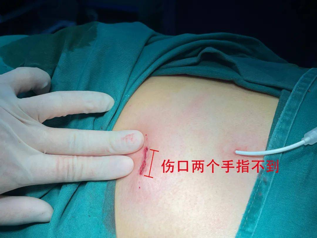 无插管全麻——让早期肺癌患者切除后快速苏醒康复_手术_麻醉_上海