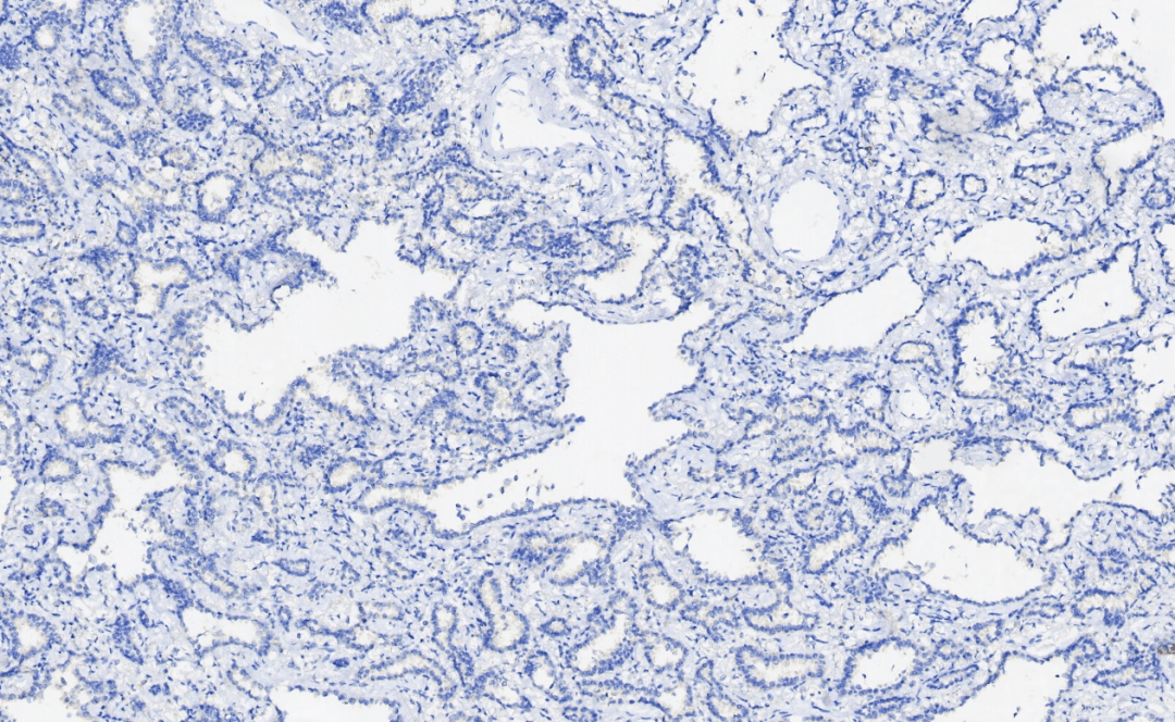 免疫组化在鉴别细支气管腺瘤与肺腺癌诊断中的应用_结果_染色_细胞