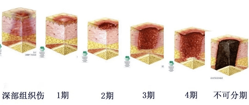 预防压疮,拒绝躺平