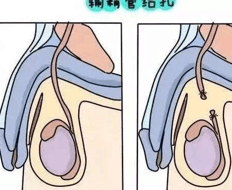 所以說如果有男人願意為你結紮的話,一定要好好珍惜這個男人.