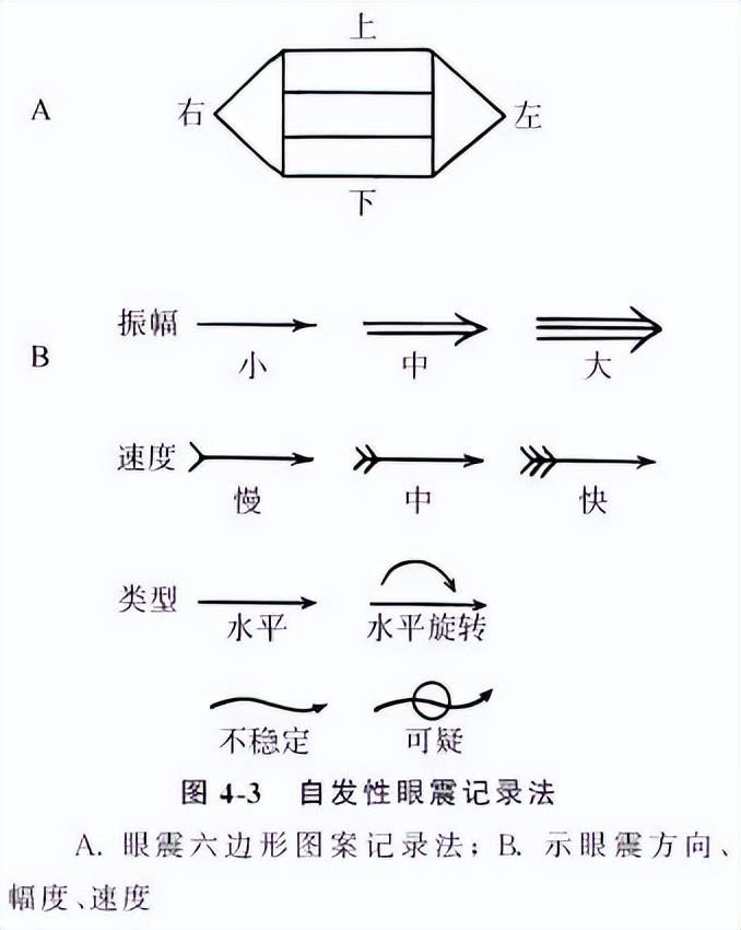 眼震图前庭功能检查图片