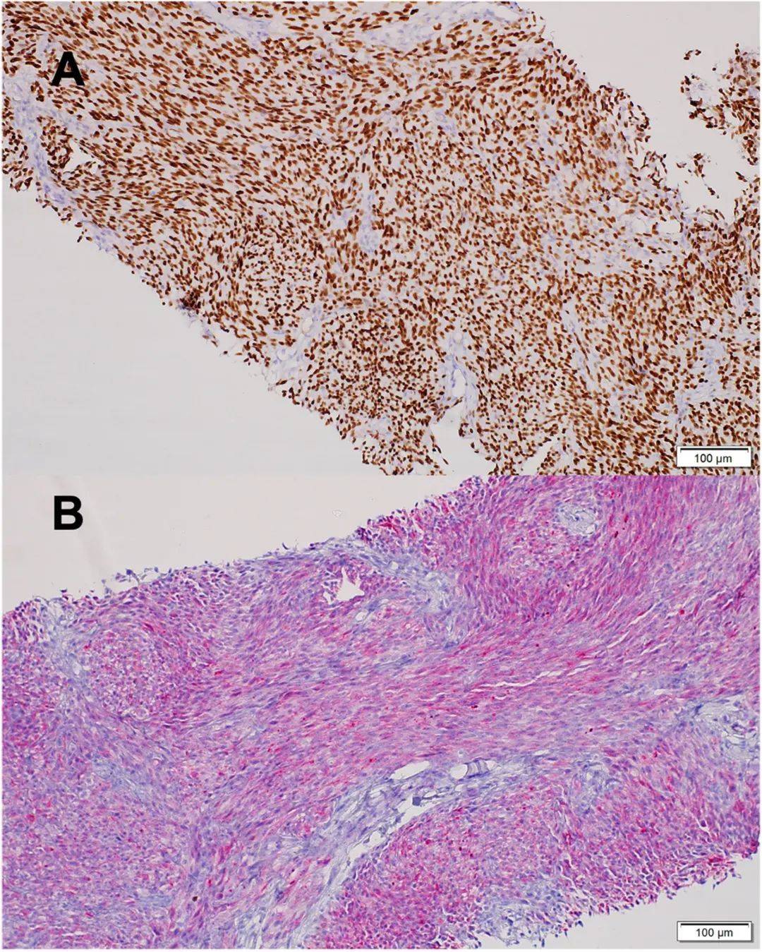 治疗助力转移性透明细胞肉瘤患儿实现疾病稳定_患者_进行_恶性肿瘤