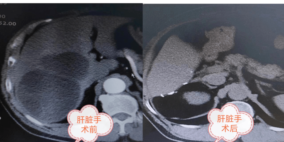 (患者術後複查ct影像)確診後,陳先生立即到新疆某三甲醫院行肝包囊