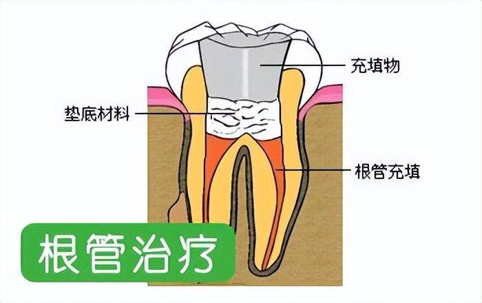 昆明口腔科普:牙齿根管治疗需要注意什么