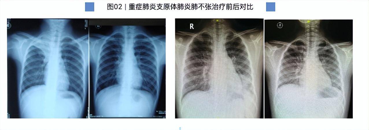 7岁男童肺部实变!有医院一天67例“洗肺”,医生紧急提醒