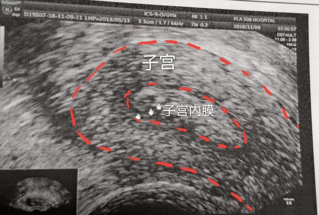 子宫内膜厚度b超图片图片