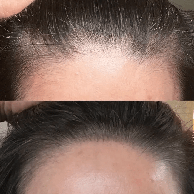 2024年第一次纹发_非手术治疗_头皮_进行