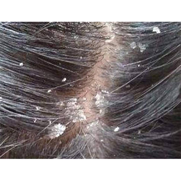 控油洗发水和去屑洗发水有什么区别?洗头止痒的洗发水推荐