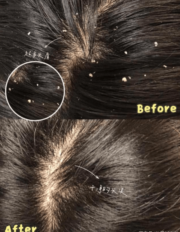 头皮屑特别多用什么洗发水?止痒控油洗发水排行榜