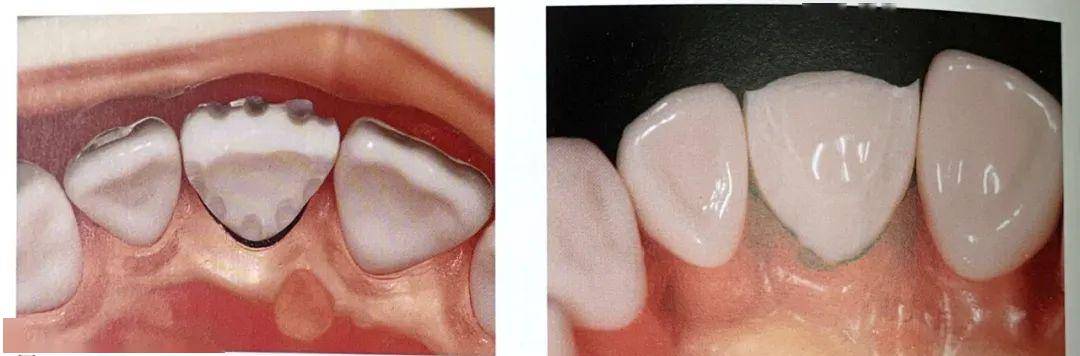 (精)前牙牙体预备要点及流程