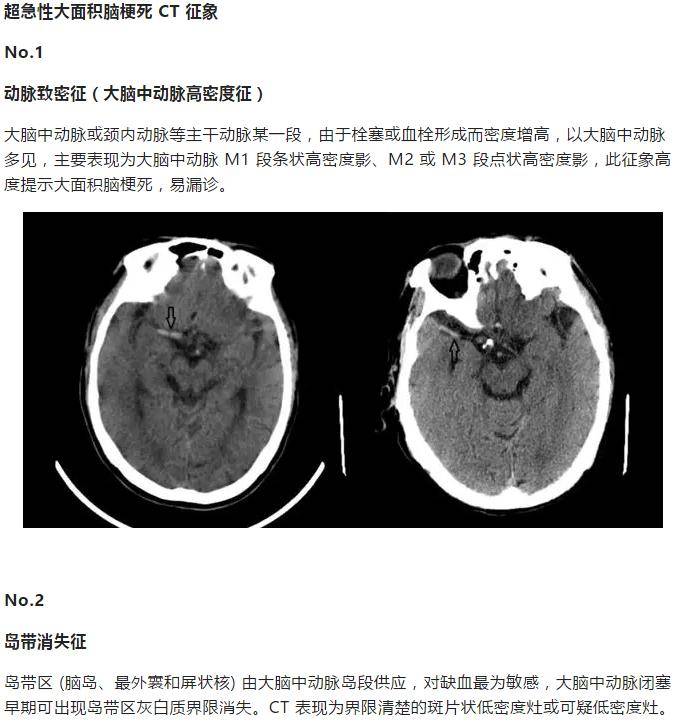 超急性期大面積腦梗死 ct 平掃表現