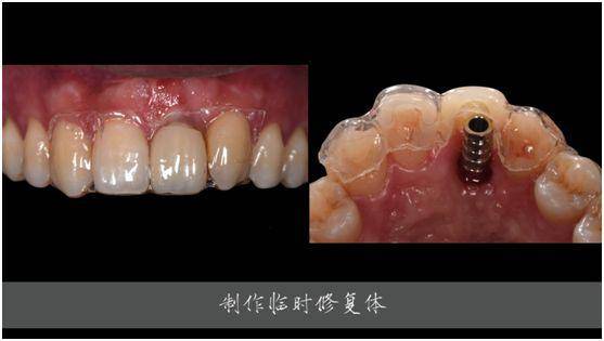 病例分享軟硬組織增量技術聯合數字化設計在美學區延期種植中的應用