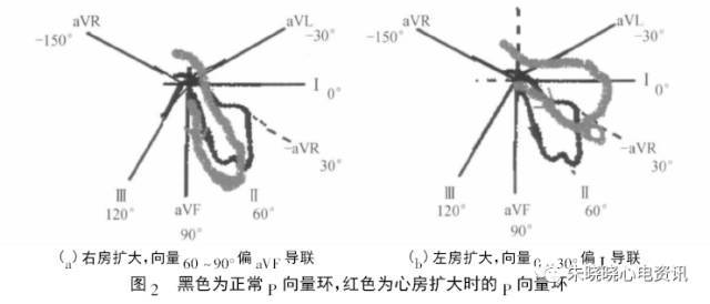 心房心室肥大的心電圖診斷